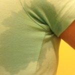 How To Manage Your Hyperhidrosis